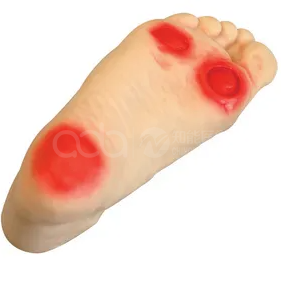 diabetic foot ulcer model