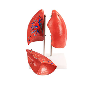 <a href=''><span style='color:#2f82c5; display:inline; font-weight:bold;'>Lung anatomy model</span></a>